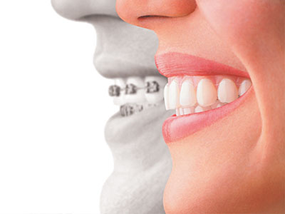 The image shows a split-screen comparison of a person s teeth before and after dental treatment.
