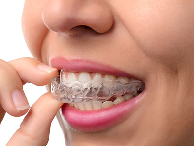 A woman wearing clear braces with white wires and adjusting her teeth with her hands.