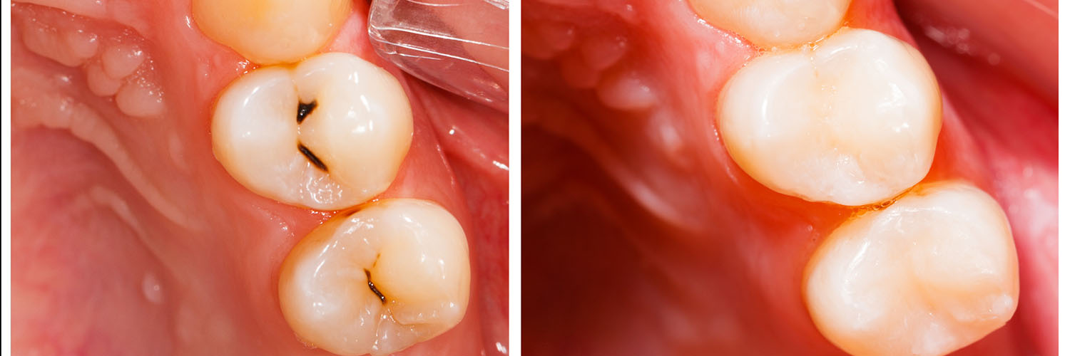 The image shows a close-up view of an oral cavity with teeth and gums, focusing on a section where a dental implant appears to be missing and a tooth is being prepared for placement.