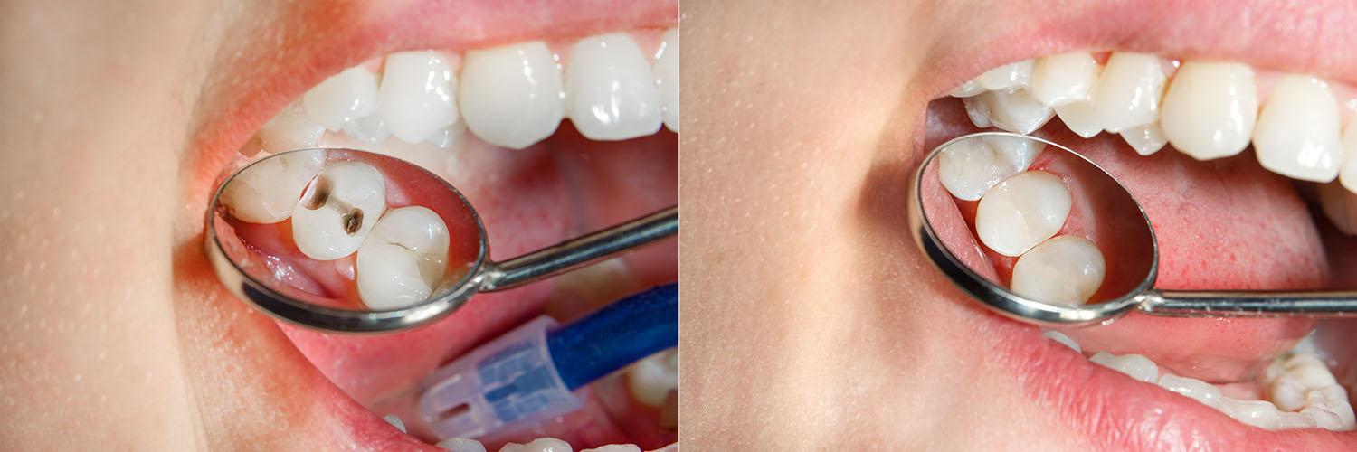 A close-up of a person s mouth with teeth being cleaned, showing a blue toothbrush and dental mirror in action.